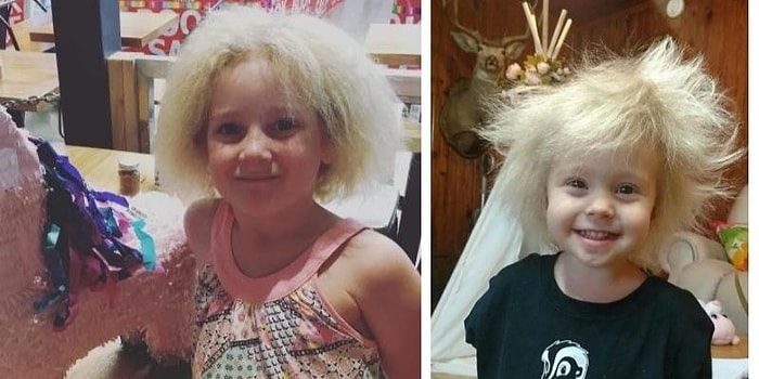 Люди-одуванчики: 6 людей с синдромом нерасчесывающихся волос