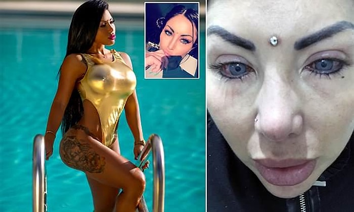 Gözlerinin Rengini Estetikle Değiştirmek İsterken Neredeyse Tamamen Kör Kalan Instagram Modeli