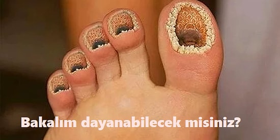 Bakalım Dayanabilecek misiniz? Tripofobi Hastasıysanız Teşhisi Koyacak 22 Fotoğraf