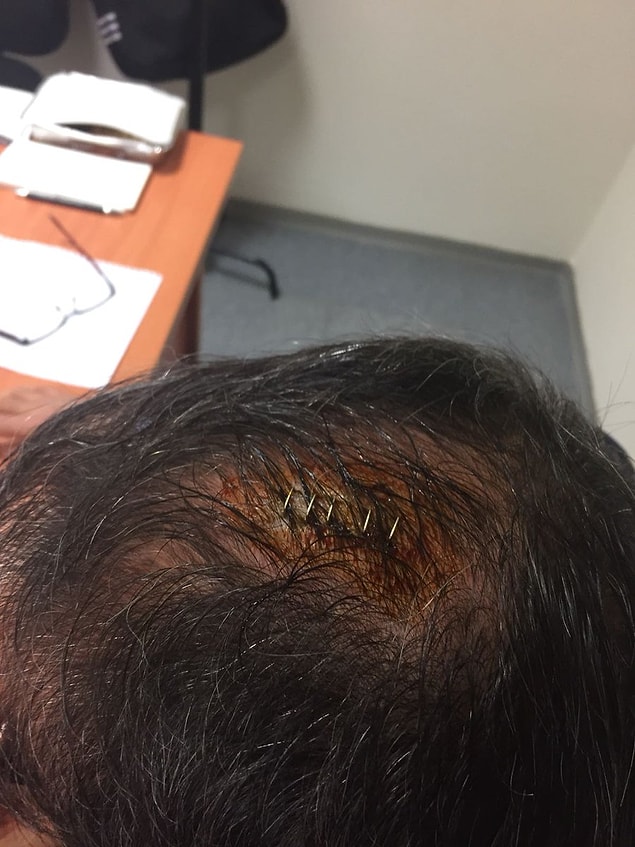 Şenol Güneş aldığı darbeden sonra 5 dikiş atılmasının ardından,