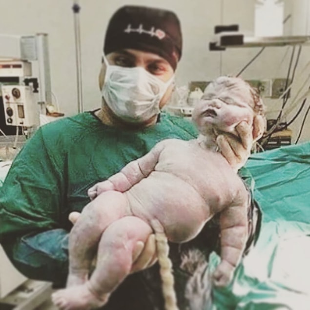 1. Doğan en ağır bebek(7,5 kg).