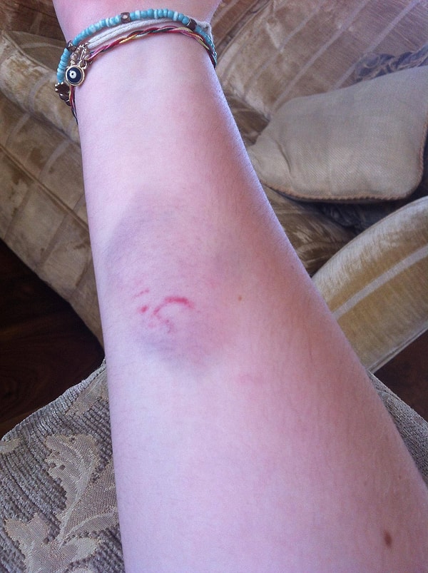 7. Синяки на теле