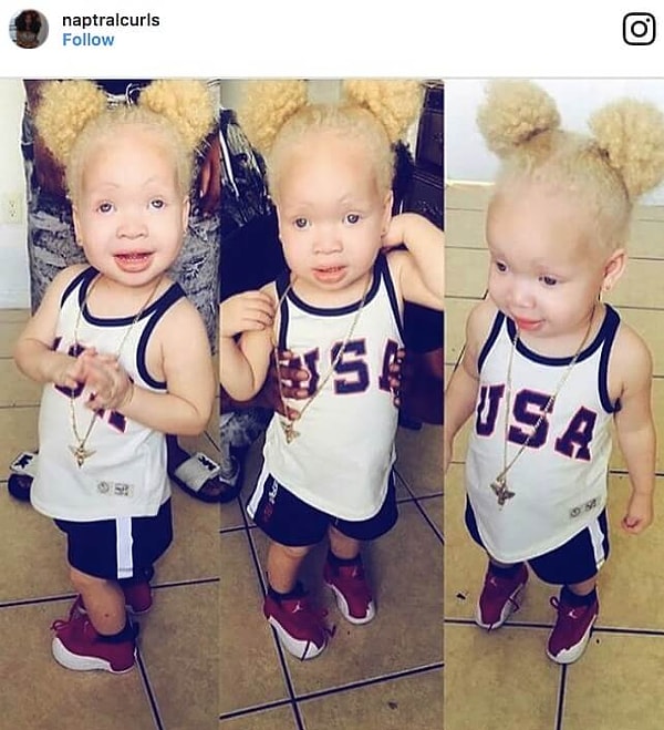 5. Ребенок-альбинос, США