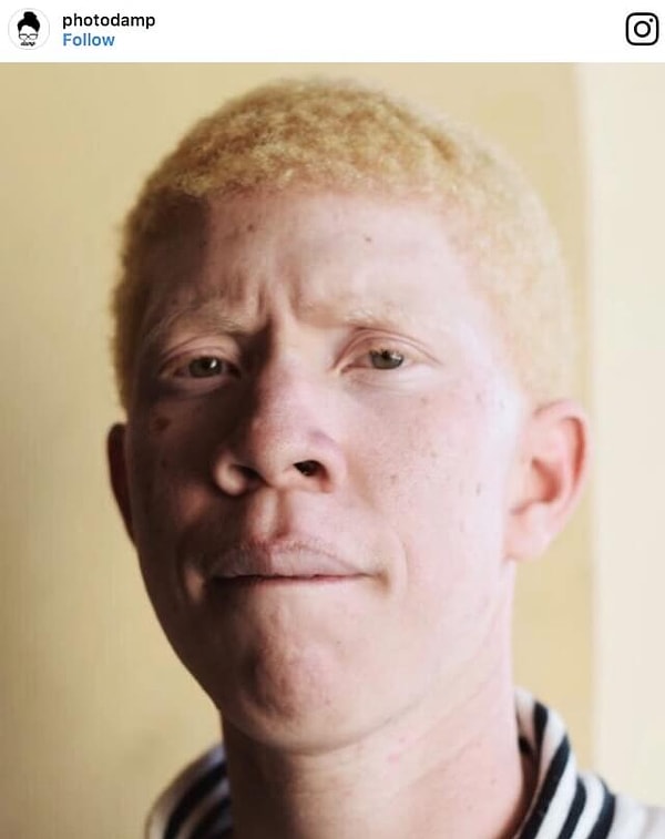 11. Парень-альбинос из Венесуэлы