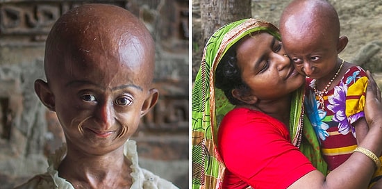 Врачи дали этой девочке всего 3 года, и она стала примером того, как надо ценить жизнь