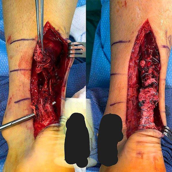 13. Bu fotoğraf bir teşhis tartışması değildi, bir doktor aşil tendon tedavisinin sonucunu paylaştı.