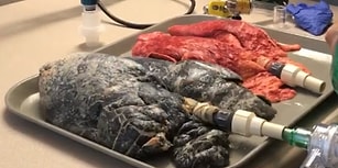 20 Yıl Boyunca Günde 1 Paket Sigara İçen Kişinin Akciğeri ile Sigara İçmeyen Akciğer Karşılaştırması