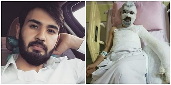 Set ‘Kaza’ları Bitmiyor: TRT’nin Yeni Çekilen Dizisinde Oyuncu Feci Şekilde Yanarak Ağır Yaralandı