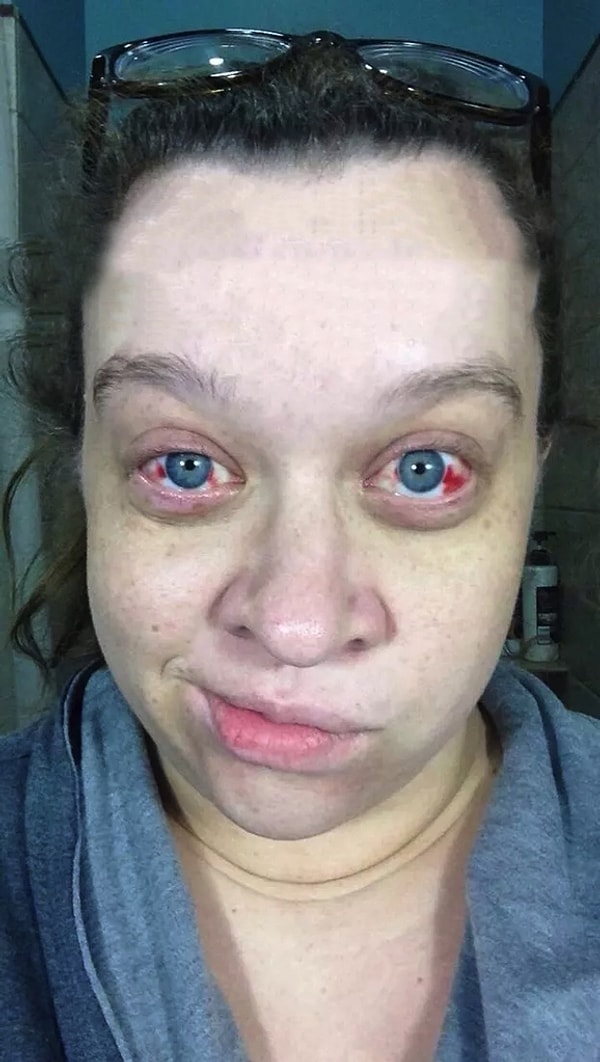 5. "Я после эпидуральной анестезии и рождения моего ребенка"