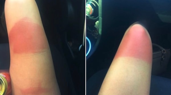 6. Оно спалит ваши оголенные коленки дотла!