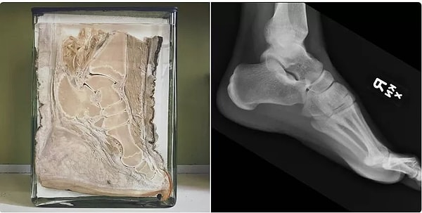 11. Кости в стопе слона выглядят как кости в стопе человека.