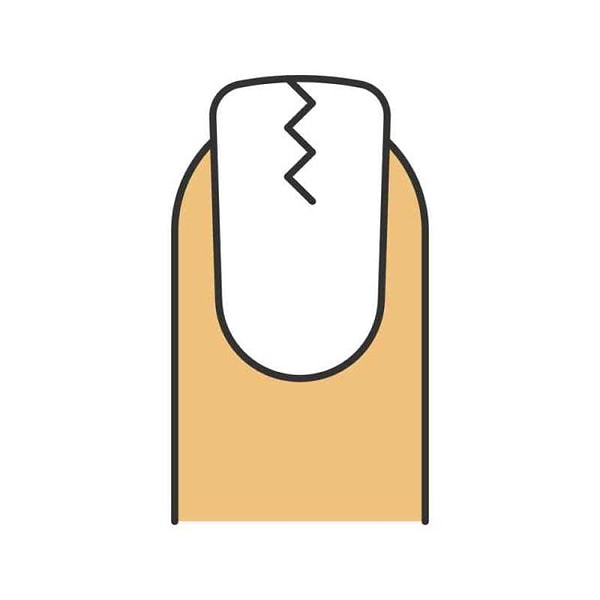 2. Хрупкие ногти и ногти с трещинами