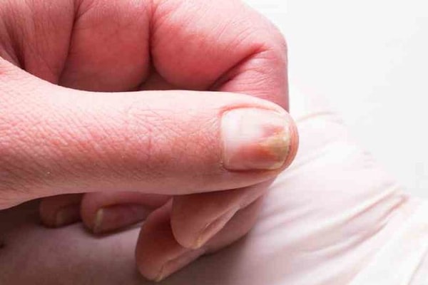 3. Дефекты ногтевой платины, например, впадины