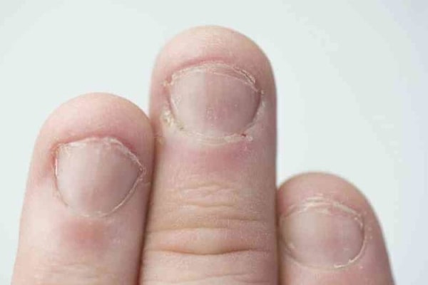 6. Сгрызенные ногти