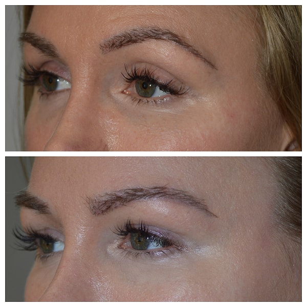 7. Филлеры для век