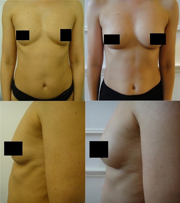 12. Эстетическая операция по увеличению груди без силикона