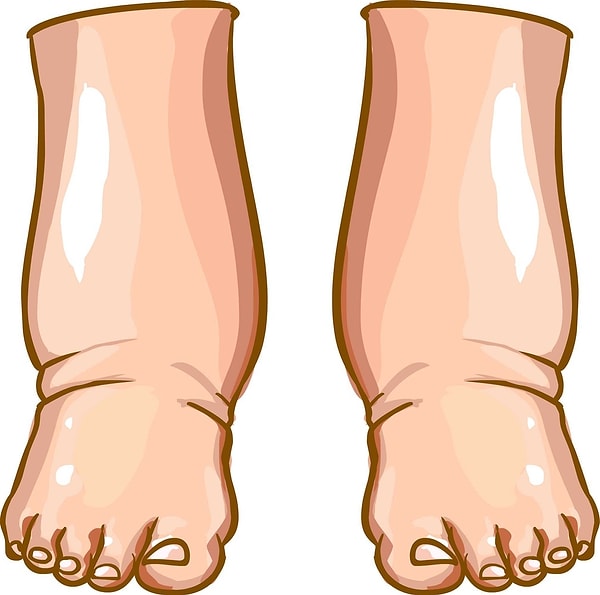 2. Отек лодыжек и ног