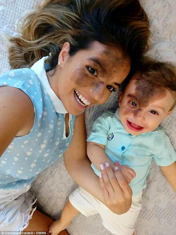 Oğlunun normal hissetmesini sağlamak isteyen anne, oğlunun yüzündeki büyük doğum izinin mükemmel bir taklidini yüzüne boyattı.