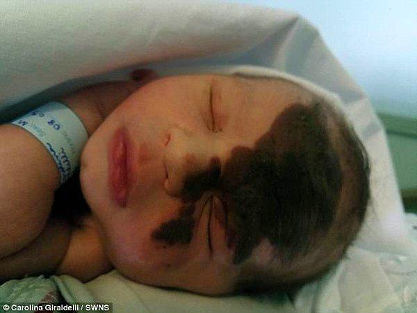 Bir yaşındaki Enzo Cestari, alnının çoğunu kaplayarak yüzünün tek tarafından burnuna kadar uzanan bir doğum lekesi ile doğmuştu.