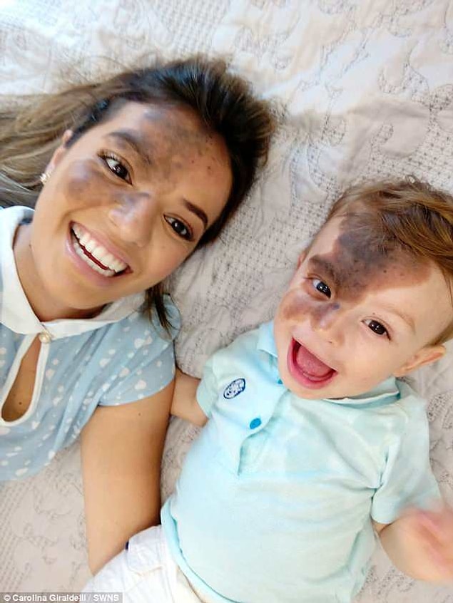 Enzo henüz 5 günlükken lekenin zararlı olup olmadığını öğrenmek için ameliyat olmak zorunda kalmış. Şimdiyse annesi lekeyi asla saklamamaya yemin etmiş, çünkü bunun oğlunun doğal hali olduğunu biliyor.