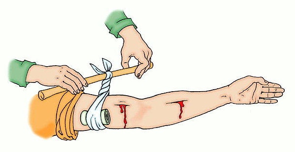 5. Каково максимальное время наложения жгута летом?