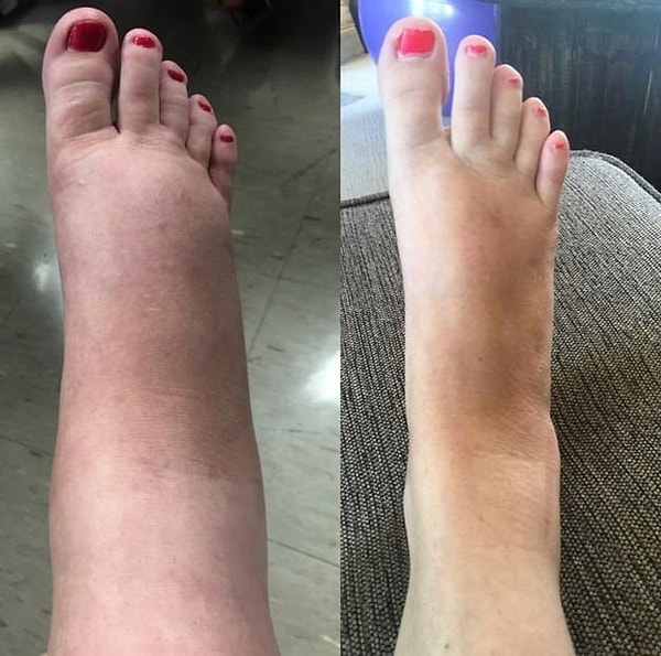 1. Стопа при беременности vs. обычная стопа