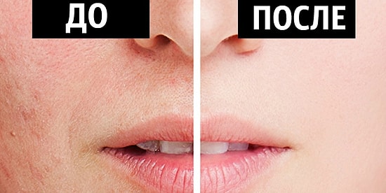 6 натуральных рецептов для того, чтобы попрощаться с расширенными порами