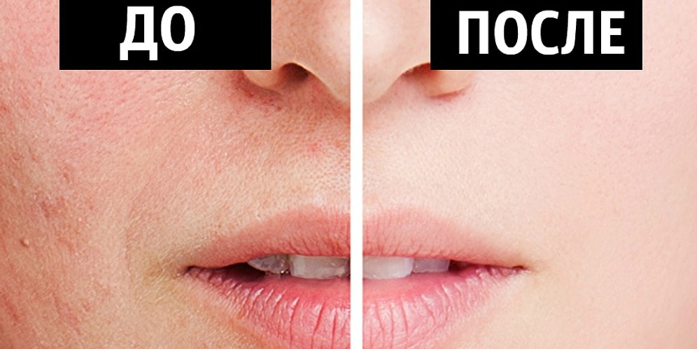 6 натуральных рецептов для того, чтобы попрощаться с расширенными порами