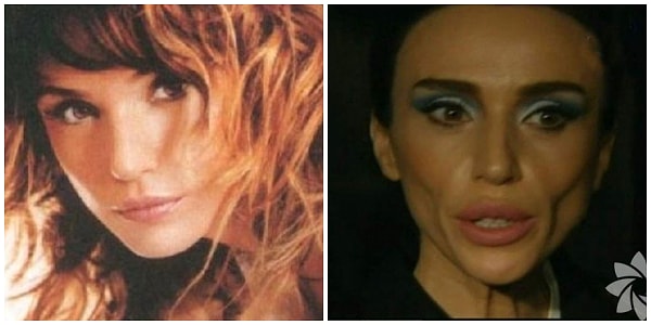 Сама по себе операция дает неплохие результаты, главное - найти хорошего хирурга и не переусердствовать)))