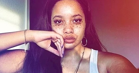 Веснушки, из-за которых в детстве Мелоди пролила море слез, помогли ей стать известной моделью