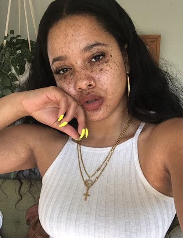 "Как-то раз я пришла домой вся в слезах из-за очередной перепалки с ребятами, а мама сказала: 'Не расстраивайся, на своем лице ты видишь следы ангельских поцелуев. Ангелы прилетают ночью, чтобы поцеловать тебя'."