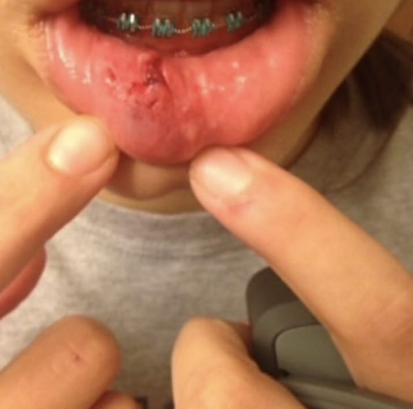 14. Слизистые оболочки ваших губ частенько могли находиться в слегка "потрепанном" состоянии 😖