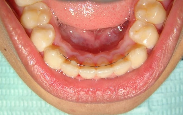 17. Но не все было так просто, ведь вас ждал ретейнер!