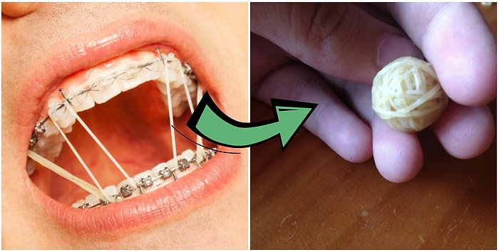 Моменты до боли знакомые тем, кто когда-то носил брекеты 😖