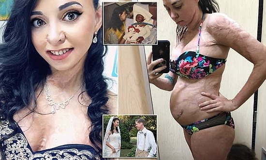 2 Yaşındayken Vücudunun Tamamı Yandıktan Sonra Öz Güveni ve Mutluluğu Aile Kurarak Bulan Kadın