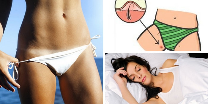 Onlara Yokmuş Gibi Davranamayız! Bikini Bölgesi Sivilceleri Hakkında Bilmeniz Gereken Her Şey