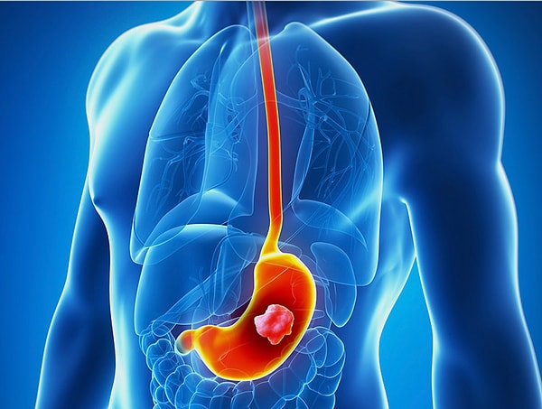 7. Густаф Эдгрен, профессор Каролинского института в Швеции, утверждает, что люди со второй группой крови более склонны к развитию рака желудочно-кишечного тракта. В качестве решения он предлагает отказаться от курения, злоупотребления алкоголем и следить за весом.