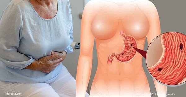 17. Представители первой группы крови более склонны к развитию язвы благодаря бактерии Хеликобактер пилори, на которую люди с этой группой имеют иную иммунологическую реакцию, нежели все остальные.