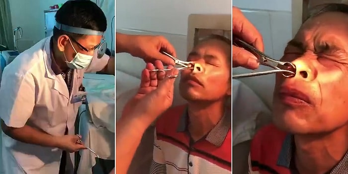 10 Gün Boyunca Burun Kanaması Şikayeti Olan Adamın Burnundan Çıkan Şeyi Görünce Şok Olacaksınız