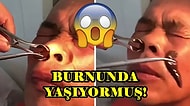 Burnunda Sülük İle Yaşadığını 10 Gün Boyunca Fark Etmeyen Çinli Adam