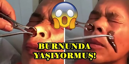 Burnunda Sülük İle Yaşadığını 10 Gün Boyunca Fark Etmeyen Çinli Adam