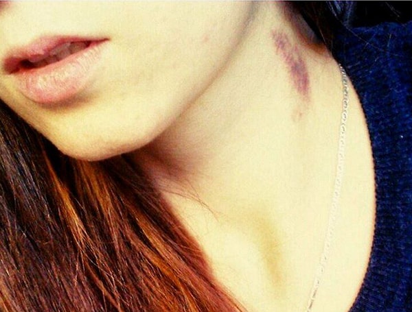 9. И все же теперь, когда вы знаете, что такое может произойти, подумайте дважды, прежде чем оставлять засос на теле своей половинки.