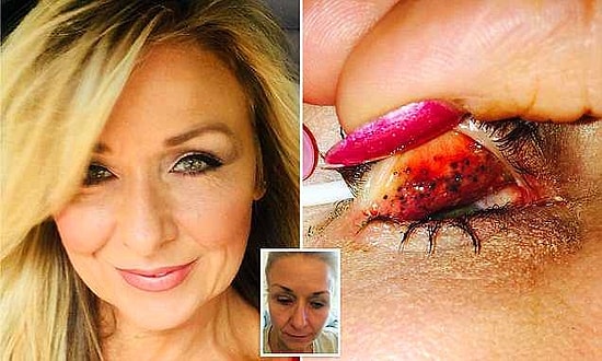 Слабонервным не смотреть! Женщина 25 лет не убирала с глаз косметику и в результате чуть не ослепла