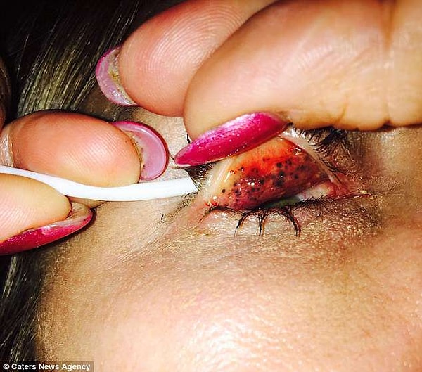 Врач, поняв, что произошло, долго не мог прийти в себя. Глаза женщины были, мягко говоря, в плачевном состоянии.