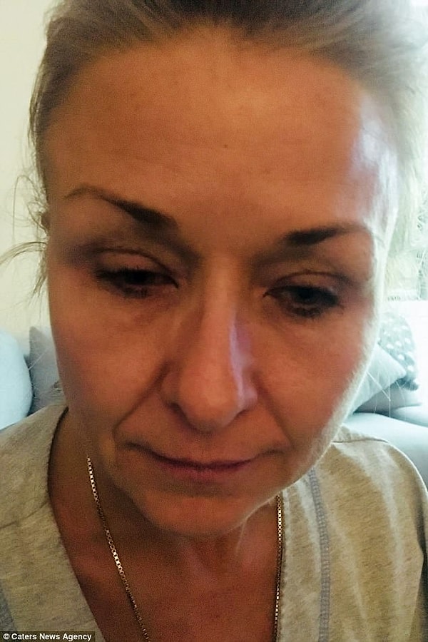 Проблема в том, что женщина не убирала тушь с ресниц перед сном. В итоге под кожей образовалось что-то похожее на черные точки.