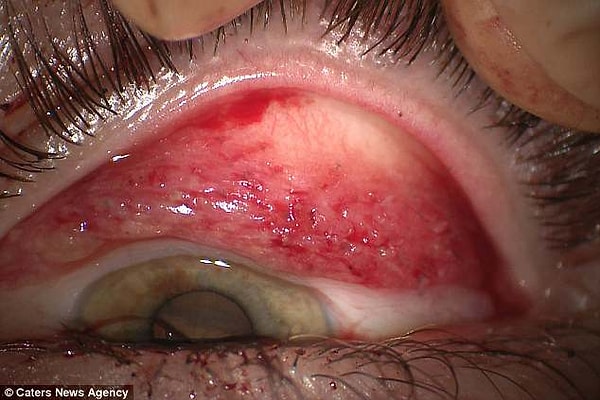 Тереза была прооперирована, глаза были полностью очищены за полтора часа.