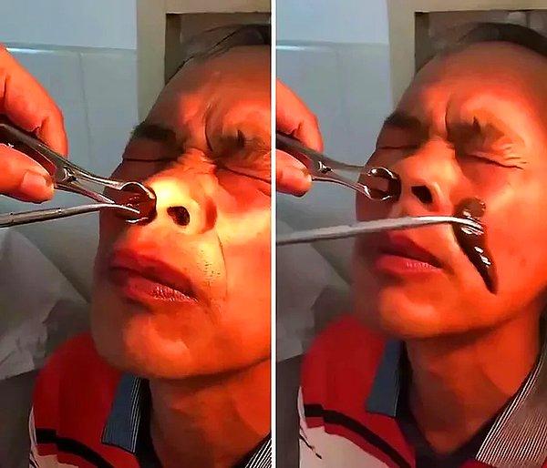 7. Çin'de bir adam nehirde yüzdüğü sırada burnuna giren sülüğü fark etmedi ve 10 gün boyunca burnunda sülükle yaşadı.