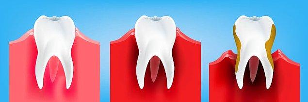 4. Periodontal hastalıkların ilerlemiş aşamaları olan hastaların çene kemiği kaybı ve diş kaybı yaşadıkları yaygındır.