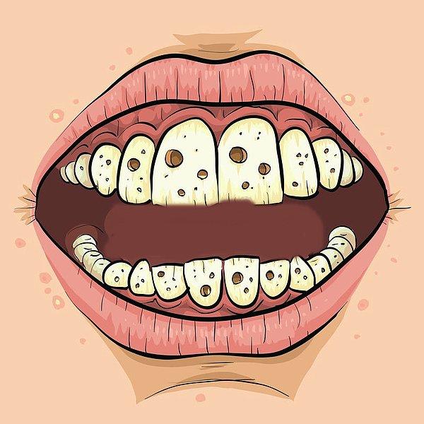 6. Çukurlar, bir süredir diş hekimi tarafından temizlenmemiş veya muayene edilmemiş bir ağzın muhtemel bir sonucudur.
