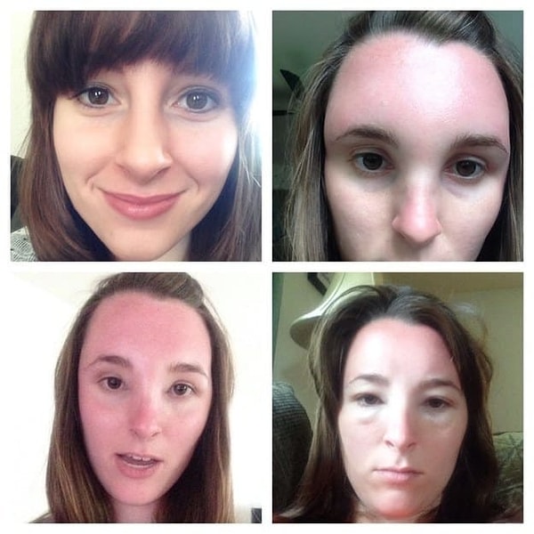 2. А еще после солнечного ожога лицо может опухать: